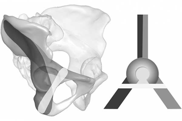 Infraacetabular screw track